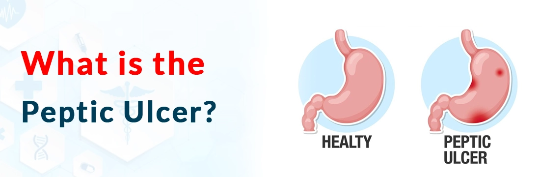 What is the Peptic Ulcer?